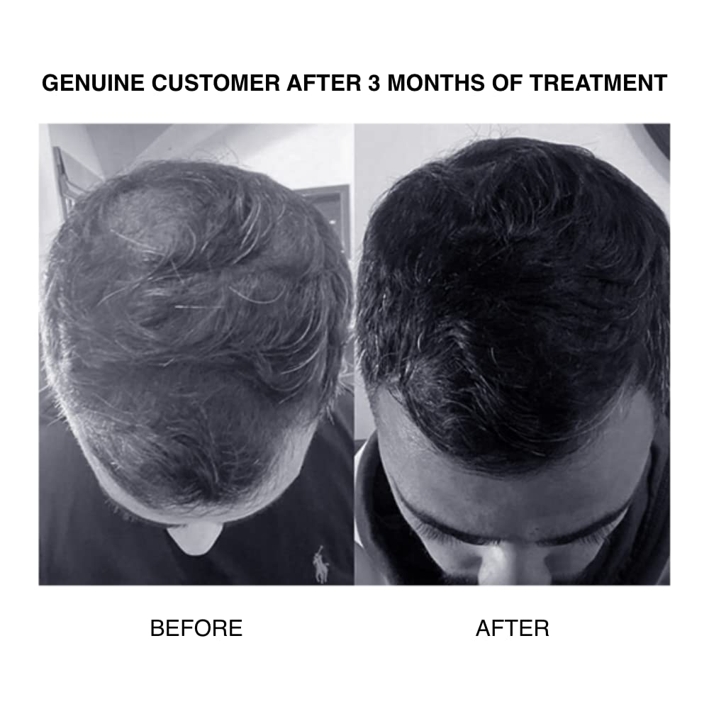 Patricks | SH plus Ultra Thickening Shampoo for Hair Loss in Men | DHT Blocker | Includes Castor Oil & Other Powerful Ingredients to Support Hair Growth | for Moderate to Advanced Hair Loss | 200Ml