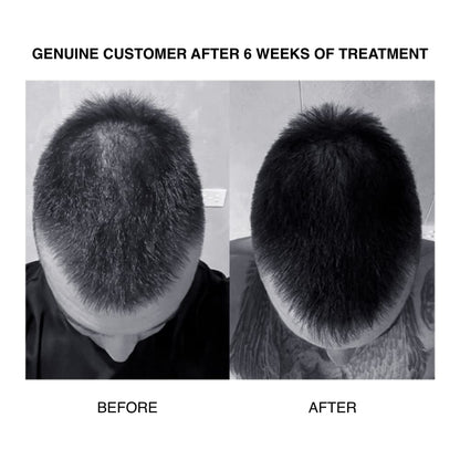 Patricks | SH plus Ultra Thickening Shampoo for Hair Loss in Men | DHT Blocker | Includes Castor Oil & Other Powerful Ingredients to Support Hair Growth | for Moderate to Advanced Hair Loss | 200Ml